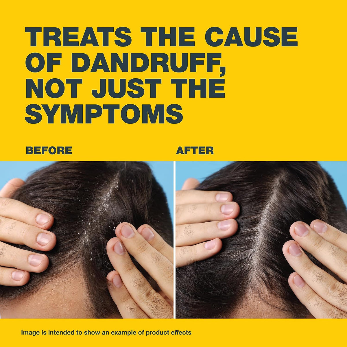 Anti-Dandruff Shampoo 100ml for Itchy Scalp and Dandruff Treatment UAE